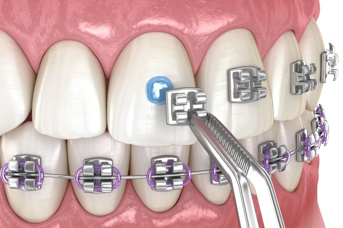 Orthodontiste Puteaux