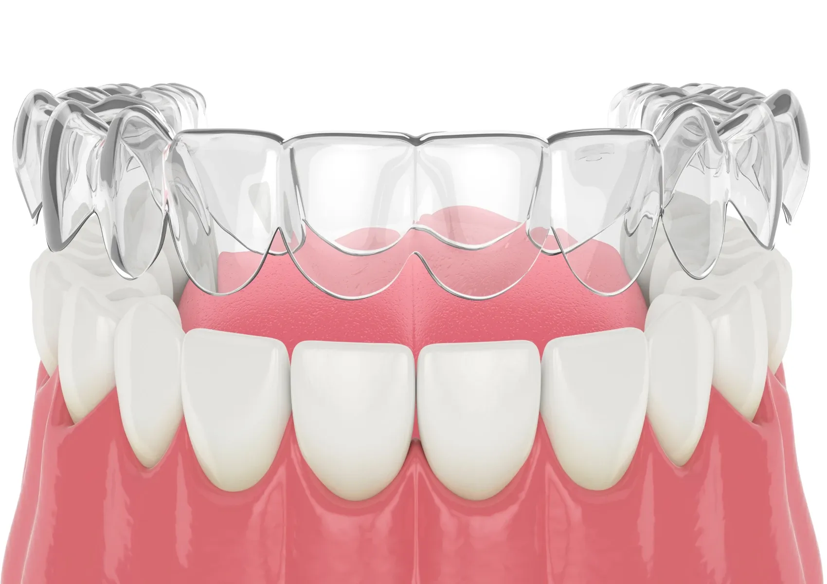 Orthodontiste adolescent Puteaux 92800