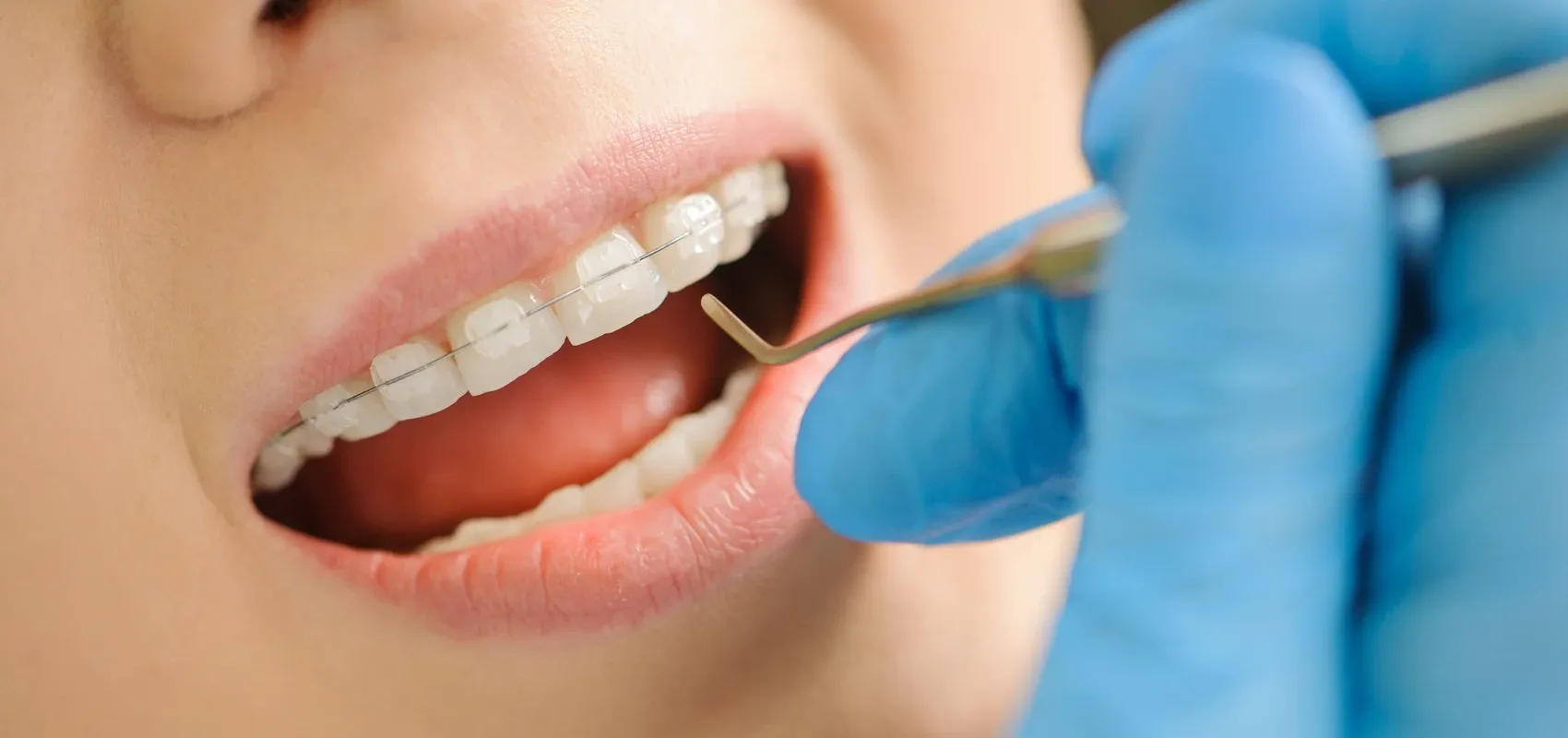 Orthodontiste adolescent Puteaux 92800